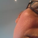 2 weeks after 2nd treatment right cheek