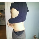 The extra skin (pre-surgery)