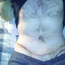 2 weeks post-op