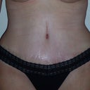 13 days post-op