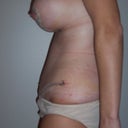 1 week post-op, I still can't stand up straight and boobs haven't dropped much