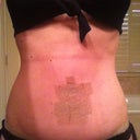14 days post op. A lot of my swelling has gone down, but still quite a bit just above my incision. I have to keep tape on for first full 6 weeks. I'll try and snap a pic and my next post op when they change out tape again next week. The red mark above the tape is from my compression girdle.