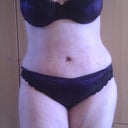 Day 6 Post Op!