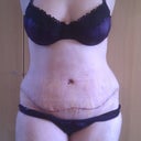 Day 6 Post Op!