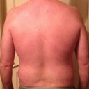 33 day post