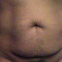 Pre op 5'7" 175 lbs.