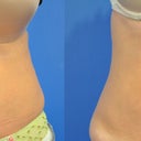 Before and 3 months after.