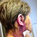 Hematoma