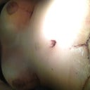 8 days PO - at surgery