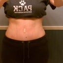 Front with clothes 6 weeks post op.. I couldn't put these on prior to surgery. I have moderate lower belly swelling.