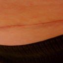 6 weeks post op- scar is disappearing. Thanks to great PS and Bio Oil twice a day.