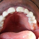 33 Year Old Patient Treated For 3 Unit Bridges