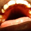 33 Year Old Patient Treated For 3 Unit Bridges
