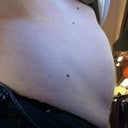 Before, side view.  You can see where the hernia was.