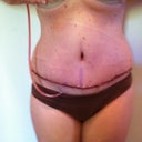 1 week p.o.  Swelling is starting