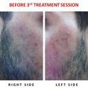 BEFORE THIRD TREATMENT SESSION