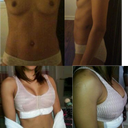 top left: before 32 AA I believe. top right: side view with little projection. bottom left: day of surgery 425 cc high profile silicon under the muscle breast fold incision.  Happy with my results can't wait for them to drop.  I'll upload no-bra shots tomorrow if I can.