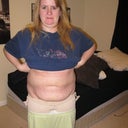 two weeks after smart lipo