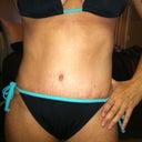 41 days PO.  Hard to believe that this will look even better at 6 months! Happy Happy Happy!