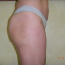 Right side 5 months post op