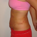 1 day post op