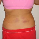 1 day post op