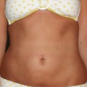 4 months post op