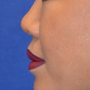 Nonsurgical Rhinoplasty Using Facial Filler