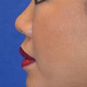 Nonsurgical Rhinoplasty Using Facial Filler