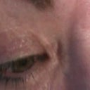 One year later - scars are really bad on inner and upper lids