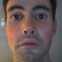 Before upper and lower mini face lift