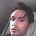 1 week post upper and lower mini face lift