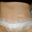 3 days post surgery