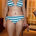 9 days post op/same bathing suit as the pre op pic;)