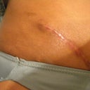 close up of high scar side. Pre-revision. Excuse the ripped underwear!! :-)