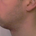 3 weeks post operation