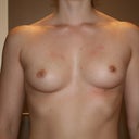 Before - from the front. I had a slight height difference. As you can see the left breast is about 0.5 cm higher than the right one. The doctor said she could correct this easily with the inframammary incision.