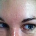 NOW. Pleated lower lids, purple tear trough (although much more obvious in person). Wrinkles when smiling despite botox given to address this.