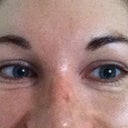 NOW. Smiling. Note multiple wrinkles under eye despite botox treatment.