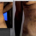 before and after lipo