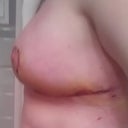 1 Week after Surgery