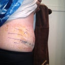 Day 1 post op scar revision and lipo.