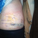 Day 1 post op scar revision and lipo.