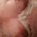 Post op pic