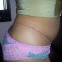 1 Month Post Op