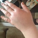 My hand 8 hrs after taking the arm wraps off I wish u girls could have seen what it looked like.. Ad least triple this size