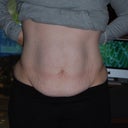 Before Tummy Tuck Frontal shot