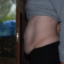 Before Tummy Tuck Side shot