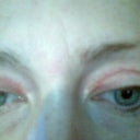 Five weeks.  Have some knotting of the scars and webbing in corners.