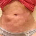4 months post op 
LUMPY, skin discoloration and some numbness